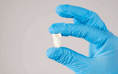 Denti del giudizio: quando vanno rimossi?