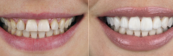 Faccette dentali: sono adatte a te?