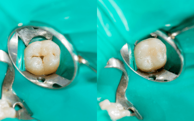 Otturazione o devitalizzazione? Differenze, quando servono e cosa aspettarsi