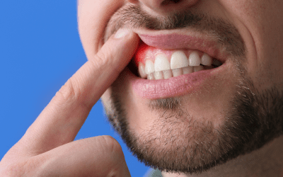 Gengive sanguinanti: quando preoccuparsi?