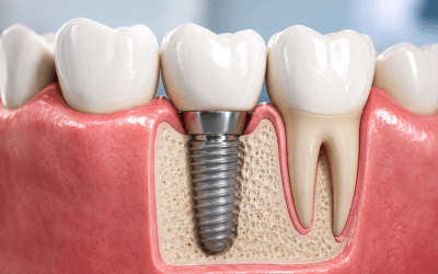 Quanto dura un impianto dentale? Fattori, rischi e come farlo durare di più